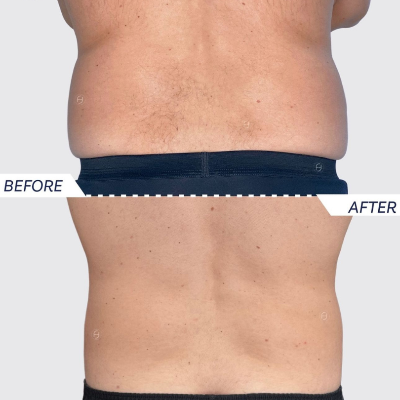 Fianchi con Coolsculpting ELITE